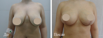 Подтяжка груди До и После