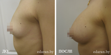 Липофилинг груди До и После
