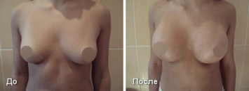 Увеличение груди До и После