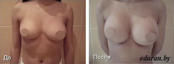 Увеличение груди До и После
