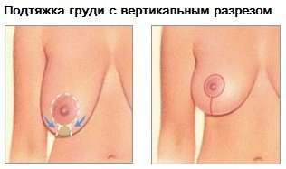 Подтяжка груди с вертикальным разрезом