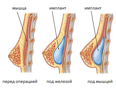 Способы установки грудного имплантата