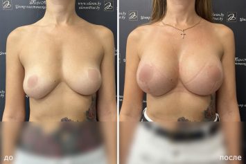 коррекция асимметрии груди с увеличением