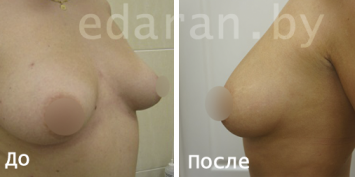 Leepofiling grudi Do i Posle