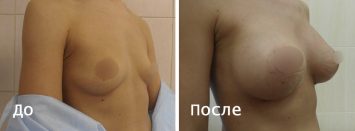 Увеличение груди (молочных желез)