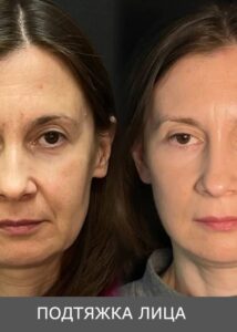 круговая подтяжка лица